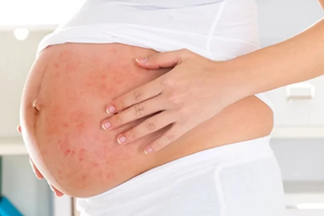 Herpes zoster per le donne incinte: 3 opzioni di trattamento