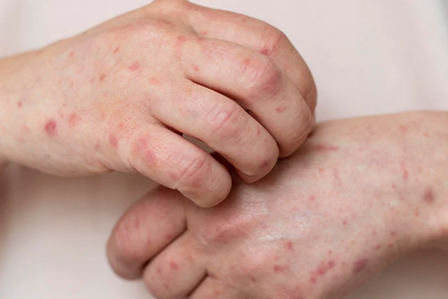 ¿Eritema infeccioso en el embarazo? Causas y tratamiento