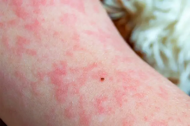 Masern bei Schwangeren: 5 wichtige Fakten zum Schutz