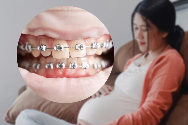 ¿Embarazadas Pueden Usar Ortodoncia? 5 Aspectos Clave