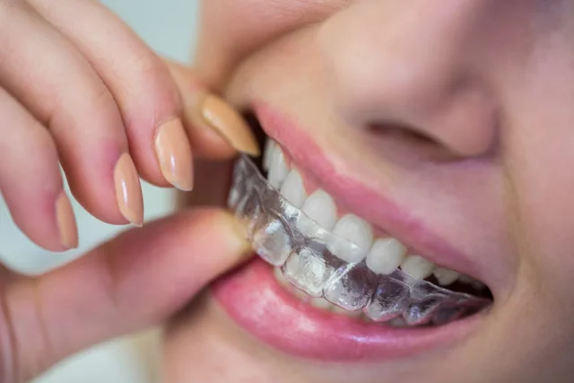 Braces Semasa Hamil: Selamatkah dan Apa Perlu Tahu?