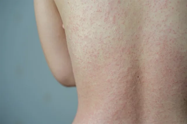 Pregnant Mothers With Measles: 5 Things You Need To Know
