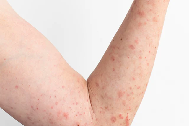 Pregnant Mothers With Measles: 5 Things You Need To Know
