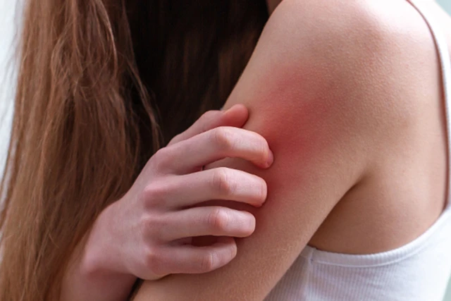 Itching in Pregnant Women: 12 Tips to Treat Itching