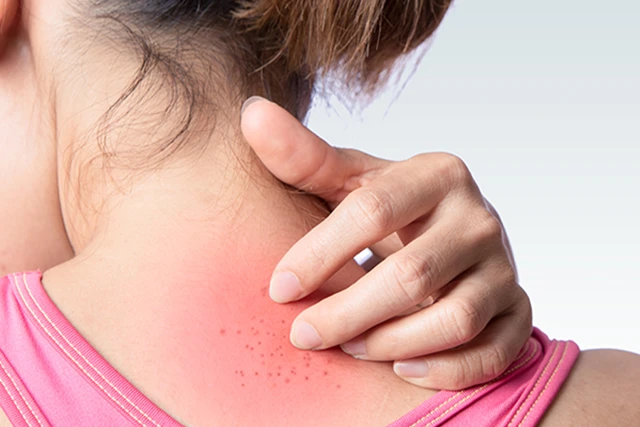 Itching in Pregnant Women: 12 Tips to Treat Itching