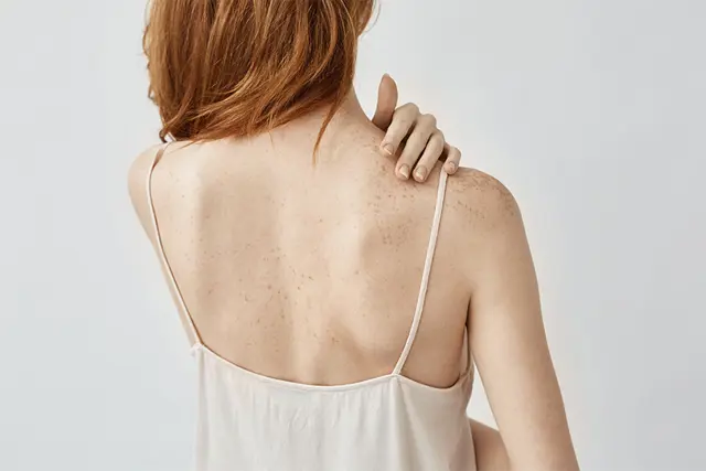 Back Acne During Pregnancy