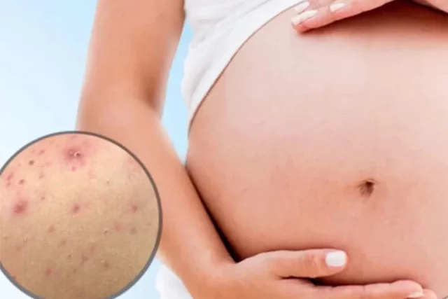 Acne sulla schiena in gravidanza, cause e soluzioni per l'ac Acne sulla schiena in gravidanza, cause e soluzioni per l'ac
