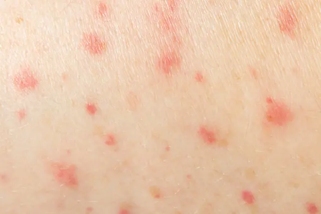 Grávidas com Sarampo: 5 Coisas que Precisa de Saber para Pro