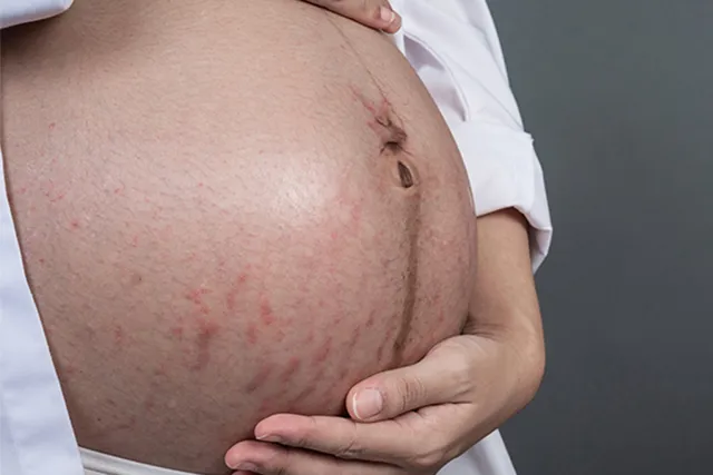 Herpes Zoster untuk Ibu Hamil: 3 Pilihan Pengobatan