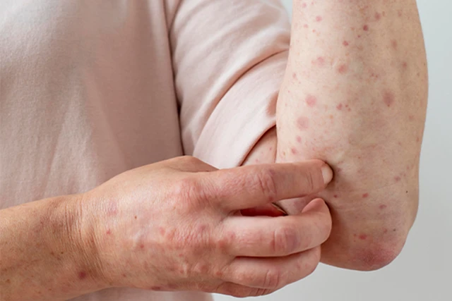 Nakakahawa ba ang Erythema sa Panahon ng Pagbubuntis?